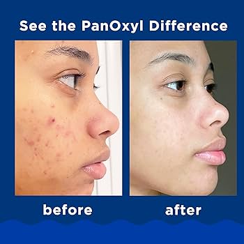 PanOxyl peroxido de benzoilo 10% Limpiador para piel con ACNE